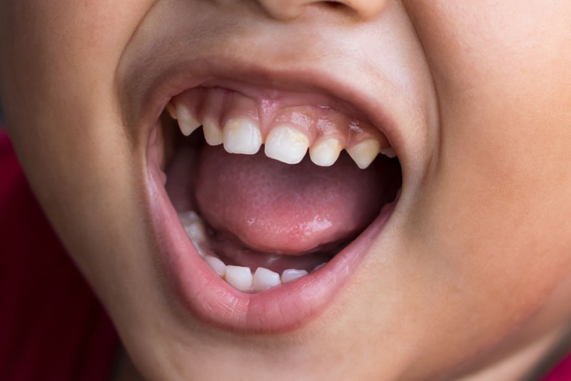 dental patient in need of frenectomy treatment