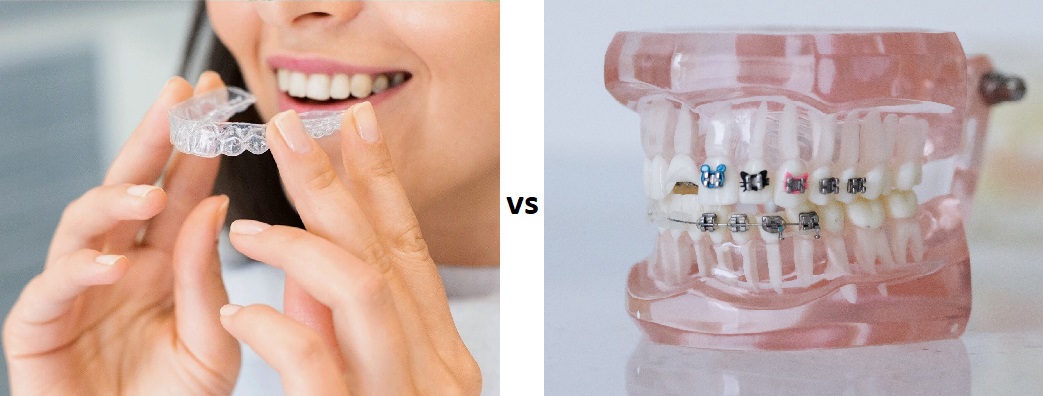 What Is The Difference Between Invisalign And Braces?