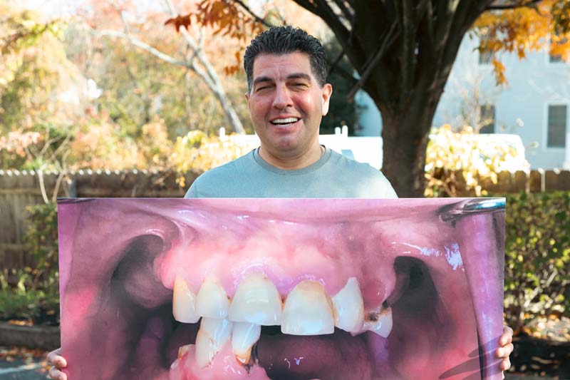 Rene All On X Dental Implants