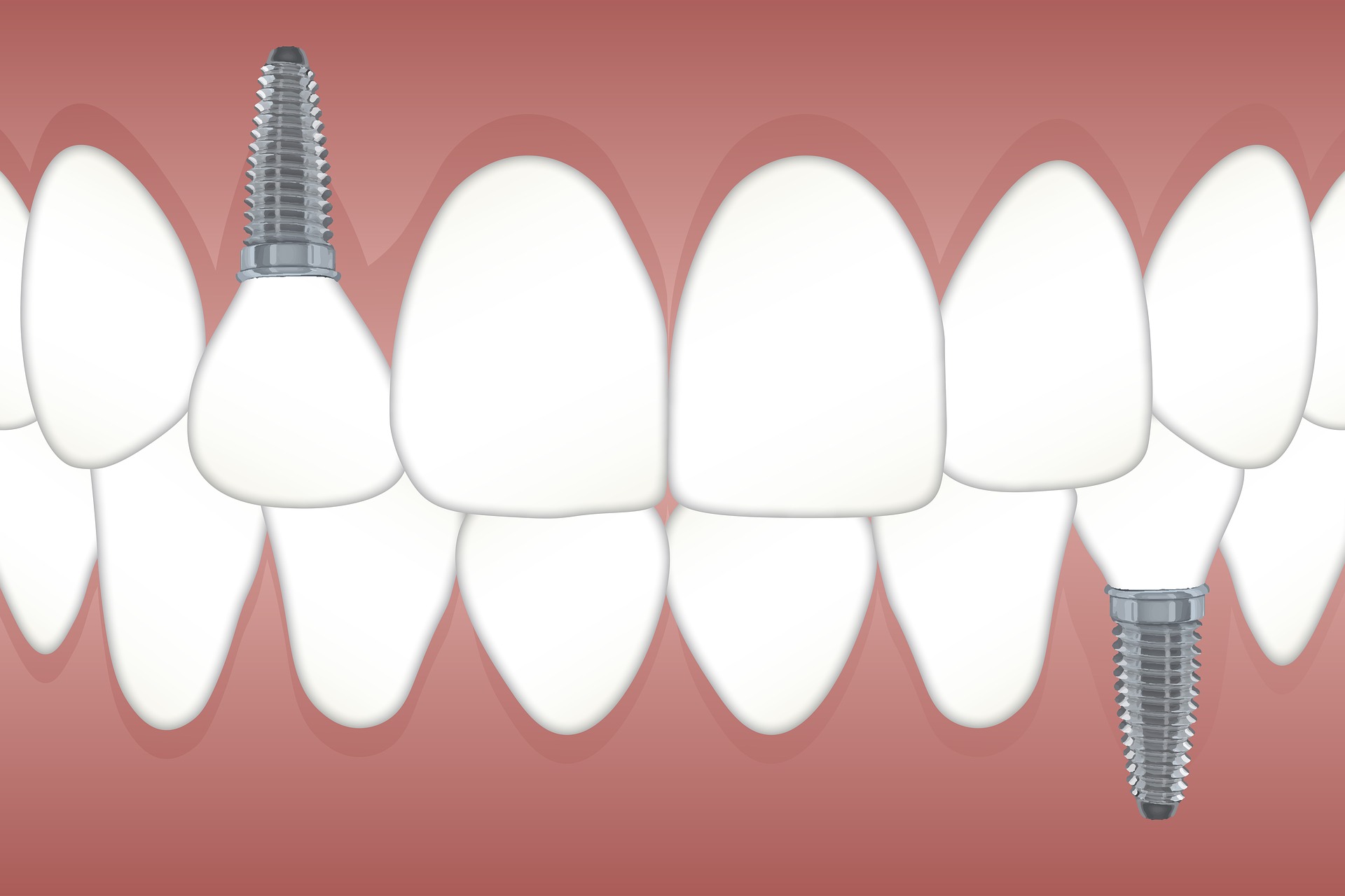 10 Reasons To Invest in Dental Implants