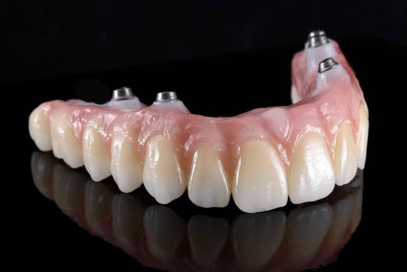 a full arch zirconia fixed bridge that has four dental implants in them so they can be securely placed in the patients jawbone.