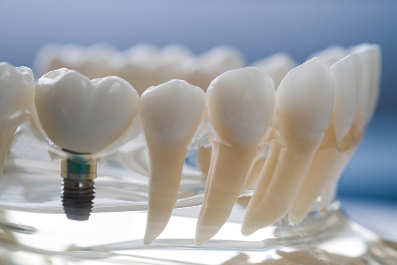After My Dental Implants Are Placed, How Will I Know If I Have Peri-Implantitis?
