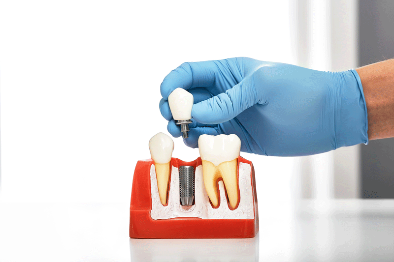 Is There A Way To Avoid Peri-Implantitis After A Dental Implant Surgery?