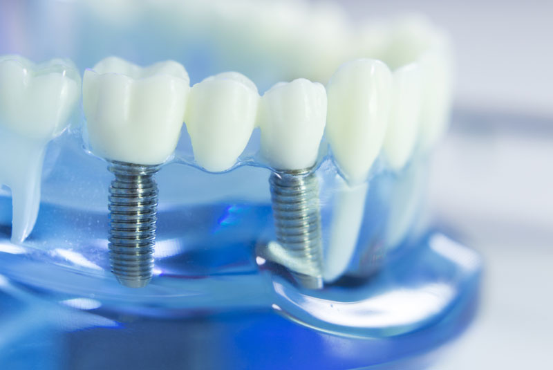 an image of a dental implant.